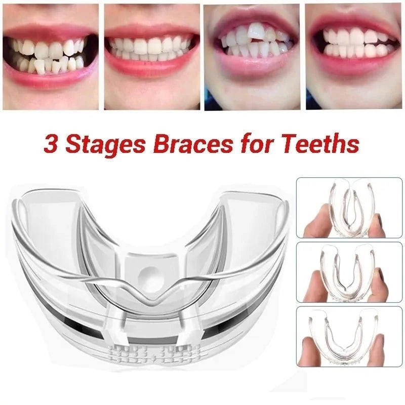 Braces Alignment Trainer Teeth